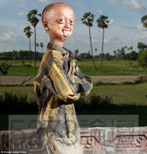 印度14歲少年患罕見早衰症　外表似老頭擁112歲身體